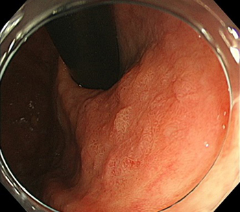 早期胃がんに対する内視鏡的粘膜下層剥離術（ESD）