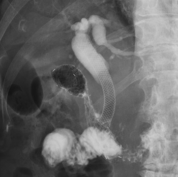 悪性遠位胆管・十二指腸狭窄に対する内視鏡的メタルステント留置術