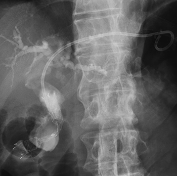 悪性遠位胆管狭窄に対する超音波内視鏡下肝内胆管胃吻合術（EUS-HGS）