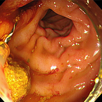 術後再建腸管の胆管結石に対するバルーン小腸内視鏡による胆管結石除去術