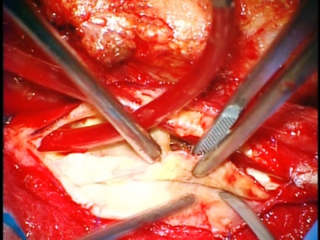 脳血管障害の外科的治療-頸動脈内膜剥離術