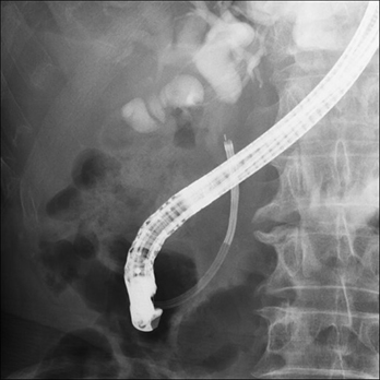 経口胆管鏡と電気水圧衝撃波胆管結石破砕装置（EHL）による胆管結石破砕術