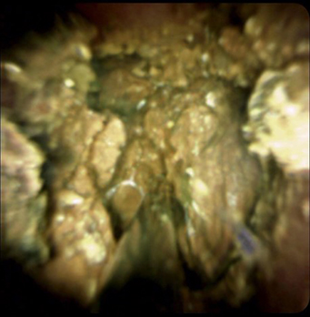 経口胆管鏡と電気水圧衝撃波胆管結石破砕装置（EHL）による胆管結石破砕術