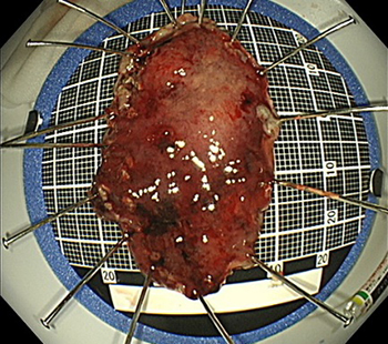 早期胃がんに対する内視鏡的粘膜下層剥離術（ESD）