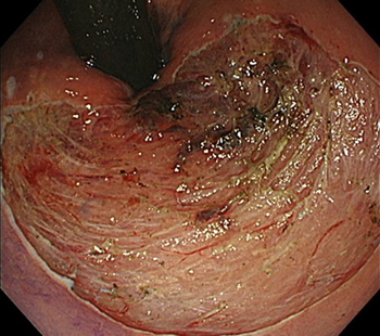 早期大腸がんに対するESD