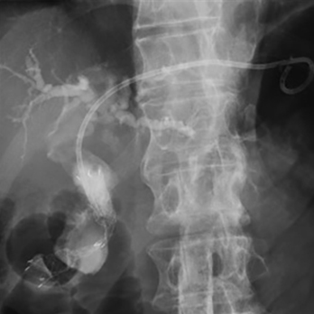 悪性遠位胆管狭窄に対する超音波内視鏡下肝内胆管胃吻合術（EUS-HGS）