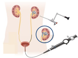 経尿道的尿管砕石術（f-TUL）併用経皮的腎砕石術（PNL）についてのイメージ