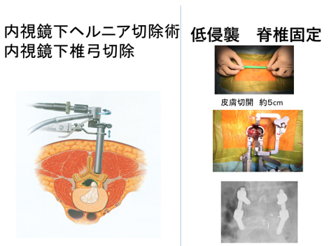 脊椎グループ-内視鏡下ヘルニア切除/内視鏡下椎弓切除/低侵襲/脊椎固定イメージ