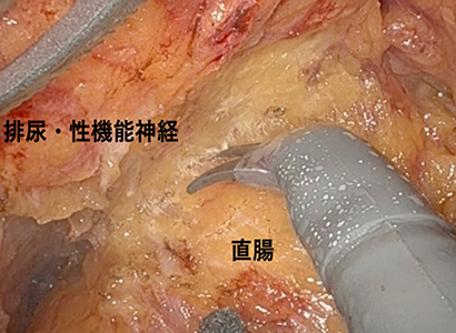 神経温存かつ病巣を完全切除