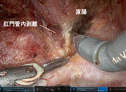 深部骨盤底での精緻な操作